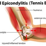 ЛАТЕРАЛЬНЫЙ ЭПИКОНДИЛИТ (ТЕННИСНЫЙ ЛОКОТЬ)