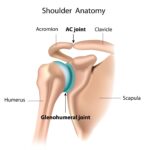Артроз акромиально-ключичного сустава
